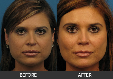 Buccal Fat Pad Removal Before & After Gallery