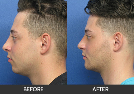 Chin Augmentation Before & After Gallery