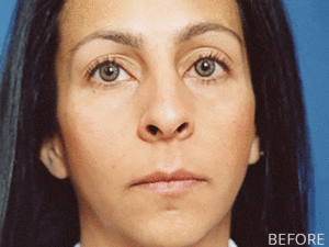 Beverly Hills Body Cheek Augmentation Before & After Photos