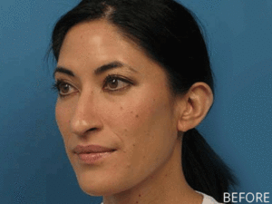Beverly Hills Body Rhinoplasty Before & After Photos