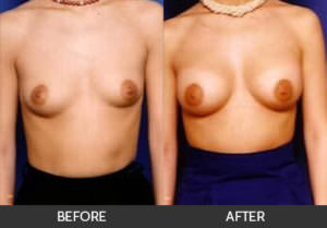 Breast Asymmetry Before & After