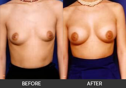 Breast Asymmetry Before & After Gallery