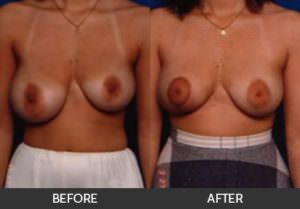 Breast Asymmetry Before & After