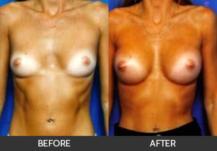 Breast Augmentation Before & After Gallery