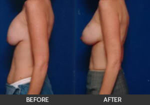 Breast Revision Before & After