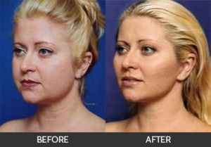 Buccal Fat Pad Removal Before & After, Beverly Hills, CA