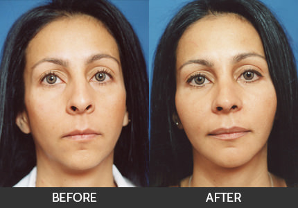 Cheek Augmentation Before & After Gallery