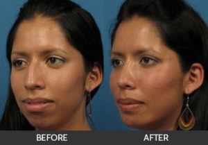 Chin Augmentation Before & After, Beverly Hills, CA