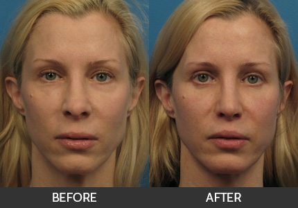 Lip Augmentation Before & After Gallery