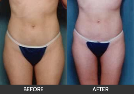 Liposuction Before & After After Beverly Hills, Los Angeles
