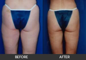 Liposuction Before & After