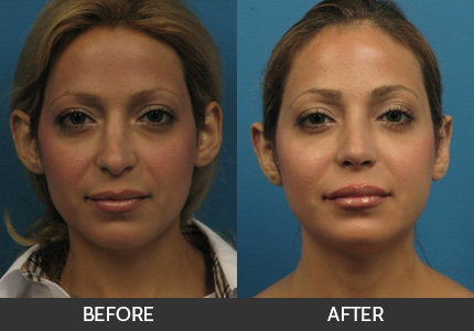 Otoplasty Before &; After Gallery