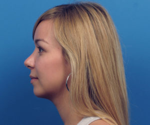 Revision Rhinoplasty After