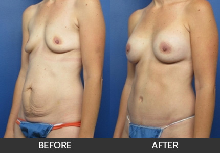 Tummy Tuck Before & After Beverly Hills, Los Angeles