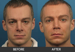 Eyelid Surgery Before & After, Beverly Hills, CA
