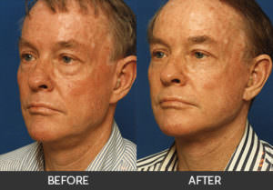 Eyelid Surgery Before & After, Beverly Hills, CA