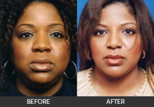 Buccal Fat Pad Removal Before & After, Beverly Hills, CA
