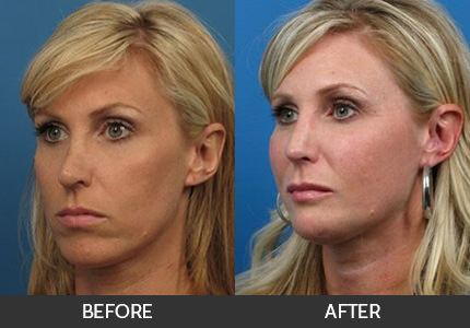 Cheek Augmentation Before & After Gallery