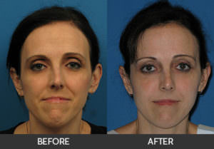 Chin Augmentation Before & After, Beverly Hills, CA