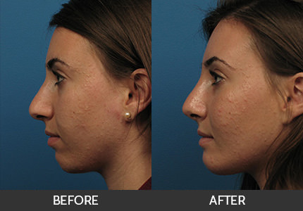 Chin Augmentation Before & After Gallery
