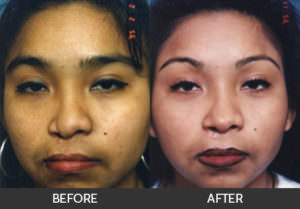 Cleft Lip & Nose Repair Before & After