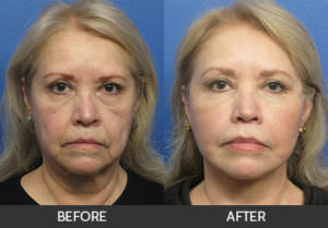 Facelift Before & After, Beverly Hills, CA