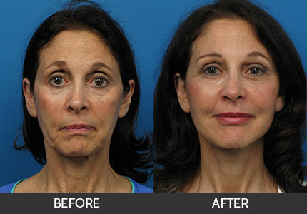Dr. Ellenbogen Facelift Before & After Photos