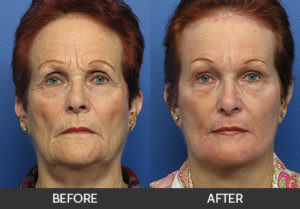 Facelift Before & After, Beverly Hills, CA