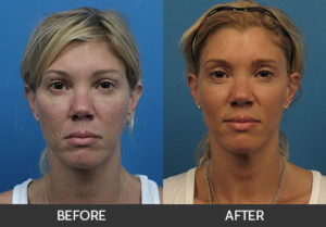 Facial Fat Grafting Before & After, Beverly Hills, CA