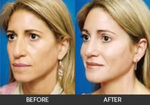 Facial Fat Grafting Before & After, Beverly Hills, CA