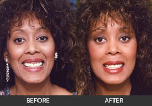 Gummy Smile Surgery Before & After, Beverly Hills, CA