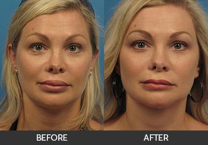 Lip Augmentation Before & After Gallery