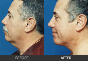 Neck Lift Before & After, Beverly Hills, CA