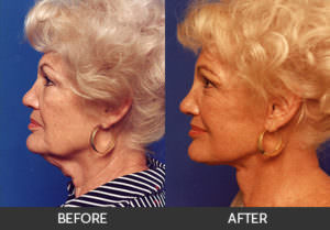 Neck Lift Before & After, Beverly Hills, CA