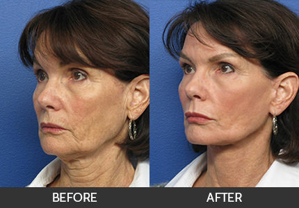 Neck Lift Before & After Gallery