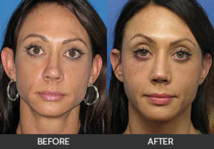 Revision Rhinoplasty Before & After, Beverly Hills, CA