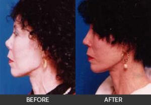 Revision Rhinoplasty Before & After, Beverly Hills, CA