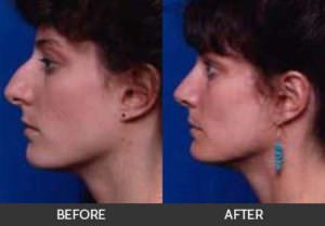 Rhinoplasty Before & After Beverly Hills, CA