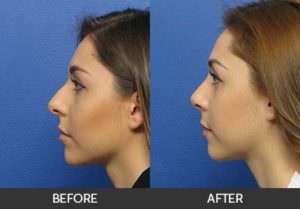 Rhinoplasty Before & After Beverly Hills, CA