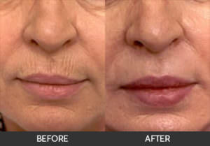 Wrinkle Reduction Before & After, Beverly Hills, CA