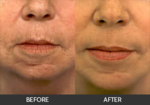 Wrinkle Reduction Before & After, Beverly Hills, CA
