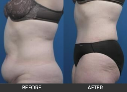Body Contouring Before & After Gallery