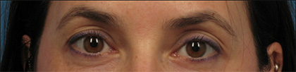 Eyelid Surgery Before - Beverly Hills, CA