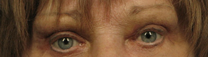 Eyelid Surgery After - Beverly Hills, CA