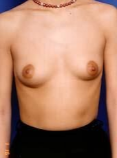 Breast Asymmetry Before - Beverly Hills, CA
