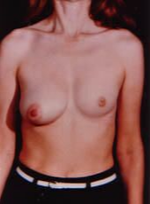 Breast Asymmetry Before - Beverly Hills, CA