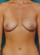Breast Augmentation Before - Beverly Hills, CA