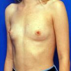 Breast Augmentation Before - Beverly Hills, CA