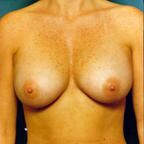 Breast Augmentation After - Beverly Hills, CA