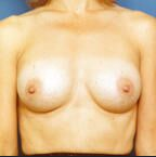 Breast Augmentation After - Beverly Hills, CA